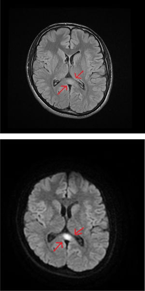 Brain MRI study: poorly-delimited lesion in the splenium of the corpus callosum, with discreet hyperintensity on T2-weighted (FLAIR) sequences (A) and marked hyperintensity on the diffusion-weighted sequence (b value, 1000) (B).
