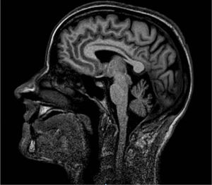 T1-weighted sagittal brain MRI scan showing cerebellar atrophy.