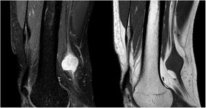 Fat-suppressed proton density–weighted and T1-weighted sagittal MRI sequences showing a lesion to the superior popliteal fossa, involving the posterior tibial nerve. The lesion is isointense on T1- weighted sequences and presents heterogeneous hyperintensity on proton density–weighted sequences. The entering and exiting nerve can be seen.