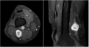 Fat-suppressed T1-weighted axial and sagittal MRI sequences with contrast administration, showing marked peripheral contrast uptake with heterogeneous central areas not displaying contrast uptake.