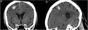 Head CT scan. Coronal (a) and sagittal planes (b) revealing a small intraparenchymal haematoma in the right prefrontal gyrus, with mild surrounding oedema.