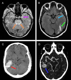 Neuroimaging studies performed in our 3 patients. A) Brain MRI scan (axial plane, FLAIR sequence) showing multiple patchy areas of corticosubcortical hyperintensity bilaterally, including the hippocampus (particularly the left; purple arrow) and the pons (orange arrows). B) Brain MRI scan (axial plane, non-contrast T1-weighted sequence) showing a hypointense region in the left hippocampus (suggestive of chronic progression; light blue arrow) and signal hyperintensity in the ipsilateral occipital region (suggestive of subacute lesion; green arrow). C) Non-contrast head CT scan (axial plane) revealing a hyperdense area in the right temporal lobe, with no intraventricular extension, and surrounding vasogenic oedema (red arrow). D) CT angiography of the supra-aortic trunks and circle of Willis confirming the presence of an arteriovenous malformation in the right temporal region (dark blue arrow), mainly supplied by the right middle cerebral artery, as well as by the right posterior cerebral artery through the lateral posterior choroidal arteries, and with venous drainage through the right transverse and sigmoid sinuses.