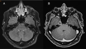 Axial T2-weighted FLAIR brain MRI scan obtained in a 3T scanner at the time of diagnosis, before treatment onset. A) The image shows numerous hyperintense punctiform foci measuring < 3mm in diameter (“salt and pepper sign”), predominantly in the infratentorial region (particularly affecting the middle cerebellar peduncles and pons), with no perilesional mass effect. B) Homogeneous gadolinium enhancement in all punctiform foci.