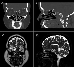 Coronal (A) and sagittal (B) face CT scans revealing a hypodense mass in the right anterior ethmoidal air cells and a defect in the ipsilateral cribriform plate. Coronal (C) and sagittal (D) brain MRI sequences confirming these findings and ruling out myelomeningocele.