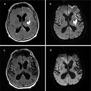 Brain MRI (axial plane). FLAIR (a) and diffusion-weighted sequences (b) reveal a lesion to the splenium of the corpus callosum, predominantly on the left side. The study performed 35 days later (c and d) reveals nearly complete resolution of the lesion.