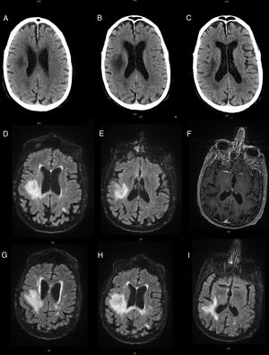 Neuroimages showing the progression of the lesion. Non-contrast head CT scans showing a hypodensity in the right hemisphere (A), and progression a week later (B and C). Brain MRI scan showing a hyperintense lesion on T2-weighted FLAIR sequences (D and E) and no contrast uptake on gadolinium-enhanced T1-weighted sequences (F). Progression of the lesions on T2-weighted FLAIR sequences (G-I).