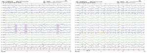 EEG studies performed on the third (left) and fifth (right) days after admission, showing generalised biphasic and triphasic sharp-wave complexes, repeated with variable periodicity.