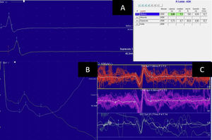 Electroneuromyography study showing normal conduction velocity and amplitude in the left ulnar nerve (A). Sensory amplitude in the superficial radial nerve was normal (B). Muscle study of the right tibialis anterior revealed small motor unit potential amplitudes, without polyphasic motor unit potentials (C).