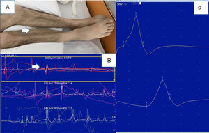Myopathy (patient 17). A) Atrophy of the gastrocnemius and tibialis anterior muscles. B) Electroneuromyography study: normal motor conduction velocity and motor potential amplitude in the right posterior tibial nerve. C) Needle electromyography of the right lateral head of the gastrocnemius muscle showing low amplitude and short duration of motor unit action potentials.