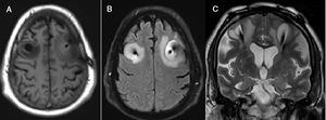 Patient 1: MRI scan revealing cerebral oedema. (A) T1-weighted sequence (axial plane) showing signal hypointensity around the electrodes. (B) FLAIR sequence (axial plane) showing peri-electrode hyperintensity, corresponding to vasogenic oedema. (C) T2-weighted sequence (coronal plane) revealing oval-shaped hyperintensity around the electrodes, compatible with vasogenic oedema.