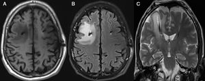 Patient 2: MRI scan revealing cerebral oedema. (A) T1-weighted sequence (axial plane) showing frontal white matter hypointensity around the right electrode. (B) FLAIR sequence (axial plane) revealing hyperintense signal secondary to vasogenic oedema around the right electrode. (C) T2-weighted sequence (coronal plane) showing a hyperintense area in the right hemisphere.