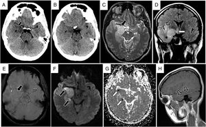 A) and B) Transverse sections from the initial head CT scan, showing findings suggestive of herpes virus encephalitis, with cortico-subcortical hypodensity in the anterior basal area of the right temporal lobe (black arrow). The images also show hypodensity with tumefaction of the amygdala and temporal uncus, resulting in mass effect and uncal herniation (white arrow). C-H) Brain MRI study obtained 3 days after symptom onset showing characteristic signs of herpes simplex encephalitis. C) T2-weighted TSE sequence (transverse plane) showing hyperintensity due to oedema, with tumefaction of the right anteromedial temporal lobe (black arrow) and hippocampus. D) FLAIR sequence (coronal plane) showing extensive cortical tumefaction of the right temporal lobe (asterisk) and extension of the hyperintensity to the right insula (hollow arrow) and hypothalamus (white arrow). E) Susceptibility-weighted imaging sequence (transverse plane) of the area of most intense involvement in the temporal lobe, with no evidence of petechial haemorrhage at 3 days of progression (black arrow). The diffusion sequence (F) and ADC map (G) show extensive right temporal hyperintensity due to the T2 effect, which is more pronounced in the cortex of the lateral gyri, with punctiform hyperintensities on the diffusion-weighted sequence (black arrows), which coincide with areas of diffusion restriction and hypointensity on the ADC map (white arrows). H) Contrast-enhanced, T1-weighted TSE sequence (sagittal plane) showing leptomeningeal contrast uptake in the basal area of the right temporal lobe (hollow arrows).