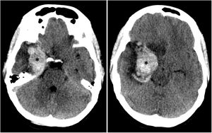 Transverse sequences from the head CT scan performed 10 days after onset, when symptoms worsened. The images are similar to those from the original study, showing a large intraparenchymal haematoma in the right temporal lobe, in the area initially affected by herpes simplex encephalitis (asterisks). The images also show perilesional vasogenic oedema and a considerable mass effect, with effacement of the adjacent sulci and greater herniation of the temporal uncus than in the initial study.