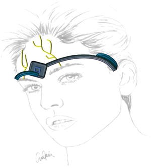 A headband-type device for stimulating the supraorbital nerves.