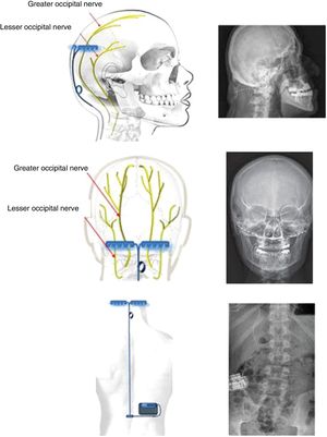 Diagrams and radiography images showing the bilateral extracranial implantation of electrodes on the occipital bone, with a subcutaneous lead connecting the electrodes to a subcutaneous generator implanted in the right lumbar fossa of a patient with chronic refractory cluster headache.