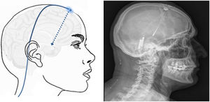 Left: electrodes implanted in the hypothalamus (blue dashed arrow) through a frontal burr hole with a subcutaneous lead. Right: postoperative CT image showing the electrode implanted in the hypothalamus in a patient with left-sided chronic refractory cluster headache.