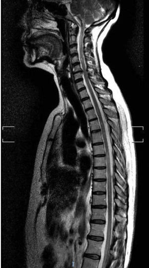 Cervical and thoracic spinal cord MRI scan. T2-weighted sequence showing hyperintensities at C1-C3, T4-T9, and T11-L2.