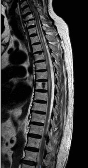 Thoracic spinal cord MRI. T2-weighted sequence revealing a hyperintense lesion at the C7-T8 level.