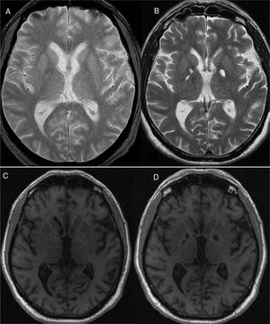 The baseline MRI study shows imperceptible lesions to the globus pallidus on T2- (A) and T1-weighted sequences (C). In a second MRI study performed 4 months later, the globi pallidi are markedly hyperintense on T2-weighted (B) and hypointense on T1-weighted sequences (D).