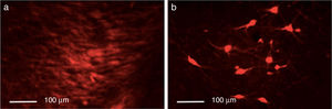 Immunoreactivity to tyrosine hydroxylase in the intact (a) and the lesioned hemispheres (b). Scale bar: 1:100μm.