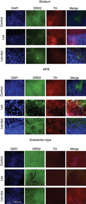 Triple immunofluorescence staining with DAPI, tyrosine hydroxylase (TH), and DRD2 in the striatum (a), medial forebrain bundle (b), and substantia nigra (c) in the groups receiving treatment. Greater cell density is observed in the striatum and medial forebrain bundle. White arrows indicate reactivity to all 3 stains (DAPI+, TH+, D2+). Scale bar: 1:100μm.