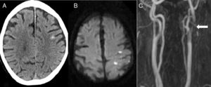 Eighty-two-year-old patient presenting sudden-onset loss of strength and sensitivity in the left arm 6 days after implantation of a left carotid stent. A) Head CT scan showing cSAH of the left convexity. B) Diffusion-weighted MRI scan revealing acute infarction adjacent to the bleeding. C) MRI-angiography showing stent thrombosis (arrow).