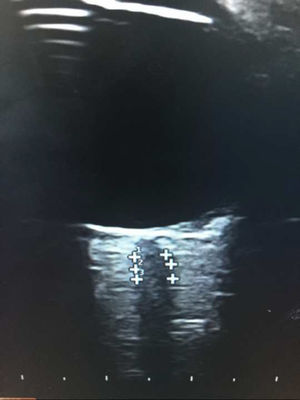 Ocular ultrasound: longitudinal image of the optic nerve from a patient with multiple sclerosis.
