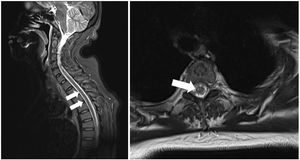 T2-weighted spinal cord MRI sequence showing hyperintensities in the anterior column extending from T2 to T7, compatible with recent ischaemic lesions.