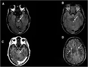Brain MRI scan (axial plane). A and B) FSE T2-FLAIR and FSE T2 sequences at the level of the orbital apex showing a focal lesion to the left posterior parasagittal region of the pons (solid arrows). C) 3D FSPGR T1 sequence after intravenous administration of single-dose contrast, revealing open ring contrast enhancement around the lesion (solid arrow); this is a frequent finding in inflammatory/demyelinating lesions. D) FSE T2 FLAIR sequence showing more than 3 lesions to the supratentorial periventricular white matter, distributed along an axis perpendicular to the lateral ventricles; these findings are also frequent in patients with inflammatory/demyelinating lesions (dashed arrows).