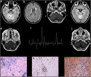 MRI findings: signal alterations in the cerebellum, midbrain, and caudate nuclei (a and b: 1.5 T, FLAIR sequence). Linear contrast enhancement of the cerebellar lesions (c: gadolinium-enhanced T1-weighted sequence). At 6 months, signal alteration was observed in the left mesial temporal lobe (d: 3 T, FLAIR sequence). At 12 months, the larger lesion, in the left cerebellum, presented pseudonodular contrast uptake (e: gadolinium-enhanced T1-weighted sequence), with a Cho/NAA ratio > 2 on the spectroscopy study (f). Six weeks after onset of radiotherapy and TMZ treatment, the cerebellar signal alteration had reduced (j: FLAIR). A histology study showed infiltration of astrocytes, forming sleeves around blood vessels (g: hippocampus section; haematoxylin and eosin stain; magnification ×400). Immunohistochemistry showed a high proliferative index and perivascular localisation of tumour cells (asterisk) (h: MIB-1 [Ki-67] staining; magnification ×200), and reactive astrocytes (arrows) distributed uniformly in contraposition to the dense perivascular aggregation of tumour cells, with variable expression of glial fibrillary acidic protein (asterisks) (i: GFAP staining; magnification ×200).