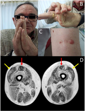(A) Contractures affecting the metacarpophalangeal and interphalangeal joints. (B) Joint hypermobility. (C) Keloid scar in the area where a muscle biopsy specimen was taken. (D) Lower-limb MRI scan showing a pattern compatible with ColVI-related myopathy: fatty degeneration in the periphery of the vastus lateralis muscles (yellow arrows) and in the periphery and anterior-central area of the rectus femoris muscles, with a U-shaped pattern (red arrows).