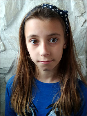 Phenotype of the patient at the age of 11. Slightly elongated face, long palpebral fissures, midface hypoplasia, deep philtrum, and bulbous tip of the nose.