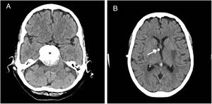 (A) Cranial CT scan showing the petroclival meningioma (asterisk) that caused compressive hydrocephalus, leading to the placement of a ventricular shunt. (B) CT scan showing the proximal end of the VAS at the right lateral ventricle.