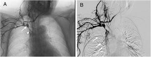 Venography showing contrast administration after catheterisation of the right cephalic vein. (A) Obstruction of the superior vena cava (arrow), with filiform passage of contrast to the right atrium (arrowhead); (B) collateral filling of thoracic wall veins towards the azygos vein (arrows).