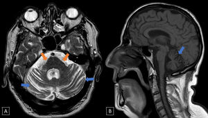 Brain MRI. (A) Axial T2-weighted sequence. (B) Sagittal T1-weighted sequence. Significant pontine (orange arrow) and cerebellar (blue arrow) atrophy, especially at the vermis. The colour figure is available in the electronic version.