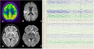 A-C) Patient 1. FDG-PET revealed hypometabolism in the posterior insula and right parietal region (A). DWI MRI showed hyperintensities predominantly in the right insula (B). Awake EEG (10-20 system) revealed bilateral slow background activity and focal epileptiform activity in the right parasagittal region (C). D-F) Patient 2. FLAIR (D) and DWI MRI (E) revealed hyperintensities in the cortex and basal ganglia, predominantly in the left hemisphere. Awake EEG (10-20 system) showed generalised theta-delta activity as well as periodic sharp waves and slow spike-and-wave complexes, predominantly in the left hemisphere (F).