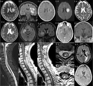 Series 1) Brain MRI: axial T2-weighted and coronal FLAIR sequences (1a and b) showing a large left frontal periventricular lesion, extending to the lenticular nucleus and insula, with a minimal mass effect on the lateral ventricle. The gadolinium-enhanced T1-weighted sequence (1c) shows irregular peripheral “cloud-like” enhancement.2 The diffusion sequence (1d and e) reveals mild restriction in the medial area, which is not suggestive of an ischaemic lesion. Series 2) Brain MRI: axial and coronal T2-weighted and FLAIR sequences showing a reduction in the size of the previous lesion (2a), and 2 new lesions: one extending towards the right basal ganglia (2b) and another predominantly left-sided lesion surrounding the third ventricle and involving the hypothalamus (2c); both lesions are gadolinium-enhancing (2d and e). Series 3) Left: spinal cord MRI. Sagittal gadolinium-enhanced T1-weighted and T2-weighted sequences (3a–c) showing multiple gadolinium-enhancing lesions, the largest extending from C4 to T2. Axial T2-weighted and gadolinium-enhanced T1-weighted sequences (3d and e) reveal heterogeneous lesions with areas of hyperintensity and hypointensity. Right: brain MRI. axial FLAIR and gadolinium-enhanced T1-weighted sequences (3f and g) show multiple new hyperintensities involving the periventricular area, corpus callosum, and left occipital lobe; most lesions present gadolinium enhancement.