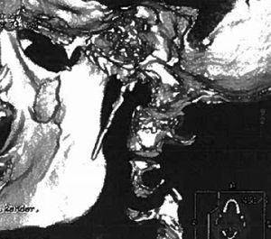 3D reconstruction of CT images showing elongation of the left styloid process, measuring approximately 50mm.