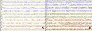 Video EEG. A) Interictal EEG showing right frontotemporal focal abnormalities consisting of periodic complex waves with a frequency below 1 Hz and variable propagation to other areas. B) Ictal EEG recording showing a generalised spike-and-wave pattern that was preceded by recruiting rhythms in the right temporal region, with fast propagation.