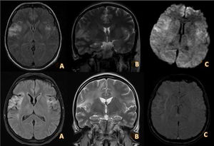 Brain MRI study performed during the acute phase (top) and at 20 days after completion of antiviral treatment (bottom). Top, A and B) Axial and coronal slices from a T2-FLAIR sequence showing hyperintense lesions extending through the insular cortex and superior temporal gyri towards the pre- and postcentral gyri and predominantly right cingulate gyrus. C) DWI sequence showing moderately restricted diffusion in the lesions described. Bottom, A and B) Axial and coronal slices from a T2-FLAIR sequence showing areas of gliosis with cystic necrosis in the insular, opercular, and bilateral frontotemporal regions, predominantly affecting the right side. C) DWI sequence showing haemosiderin deposition predominantly in the right insular area, compatible with superficial siderosis secondary to encephalitis.