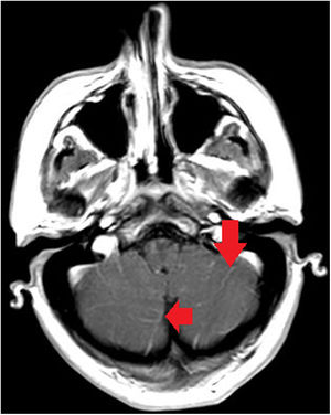 Axial T1-weighted brain MRI sequence after gadolinium administration. We observed leptomeningeal contrast uptake between the cerebellar folia (red arrows).