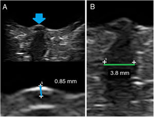 Orbital ultrasound study. We observed bilateral optic disc protrusion of 0.85 mm (A, blue line) and increased optic nerve diameter of 3.8 mm (B, green line), with no signs of oedema under the dural sheath, suggesting optic neuritis.
