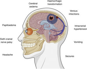 Symptoms and pathophysiological events involved in cerebral venous sinus thrombosis. Figure created with BioRender.com.