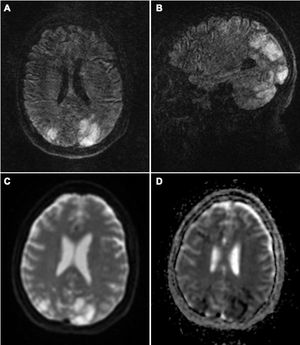 Brain MRI study: axial (A) and coronal (B) T2-FLAIR sequences showing hyperintense lesions in both cerebellar hemispheres and parieto-occipital lobes, predominantly on the left side, which do not correspond to the territory of a large vessel. DWI sequences (C) show diffusion restriction in some of these lesions, with low ADC values (D). All these signs are suggestive of severe PRES secondary to established infarction.