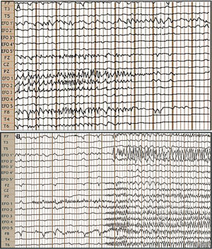 Video EEG study: bilateral foramen ovale electrodes (FOE) and complementary surface electrodes: international 10-20 system, left-to-right reference montage. A) Interictal: fast activity with bilateral (predominantly right-sided) spikes of medium voltage. B) Ictal: onset of fast, low-amplitude activity in FOE contacts 1 and 2, lasting 7 seconds, followed by propagation to the contralateral hippocampus, generating greater amplitude, and across the right temporal lobe.