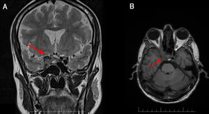 Brain MRI: axial T2-FLAIR (A) and coronal T2-weighted sequences (B) showing a mass in the right cavernous sinus.