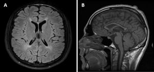 Magnetic resonance imaging study. A) Axial T2-FLAIR sequence showing periventricular white matter hyperintensity. B) T1-weighted sequence showing global atrophy, with marked atrophy of the corpus callosum.
