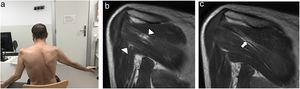 a) Patient with right scapular winging and limited range of shoulder movement. b) T1-weighted MRI sequence of the shoulder. Oedema of the bellies of the right infraspinatus and teres major muscles. c) Fatty infiltration in the belly of the right infraspinatus muscle.