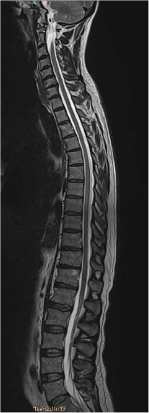 Sagittal T2-weighted MRI sequence of the spinal cord, showing slight hyperintensity of the T6-T11 segments, compatible with longitudinally extensive transverse myelitis.