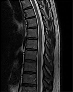 A close-up of the sagittal T2-weighted MRI sequence, showing hyperintensity of the T6-T11 segments.
